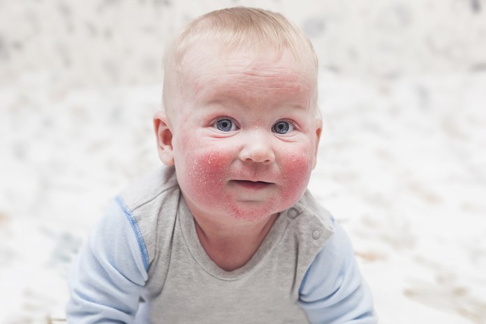 Исцеление атопического дерматита у малыша 1,5 лет